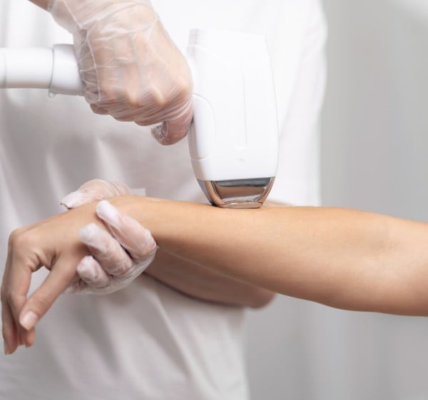 laser hair removal