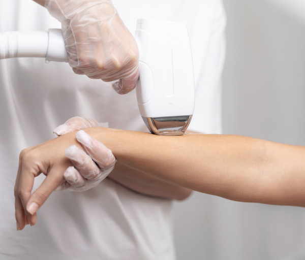 laser hair removal