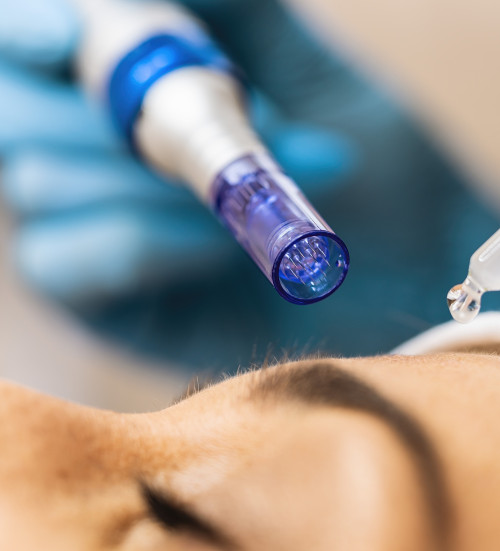microdermabrasion